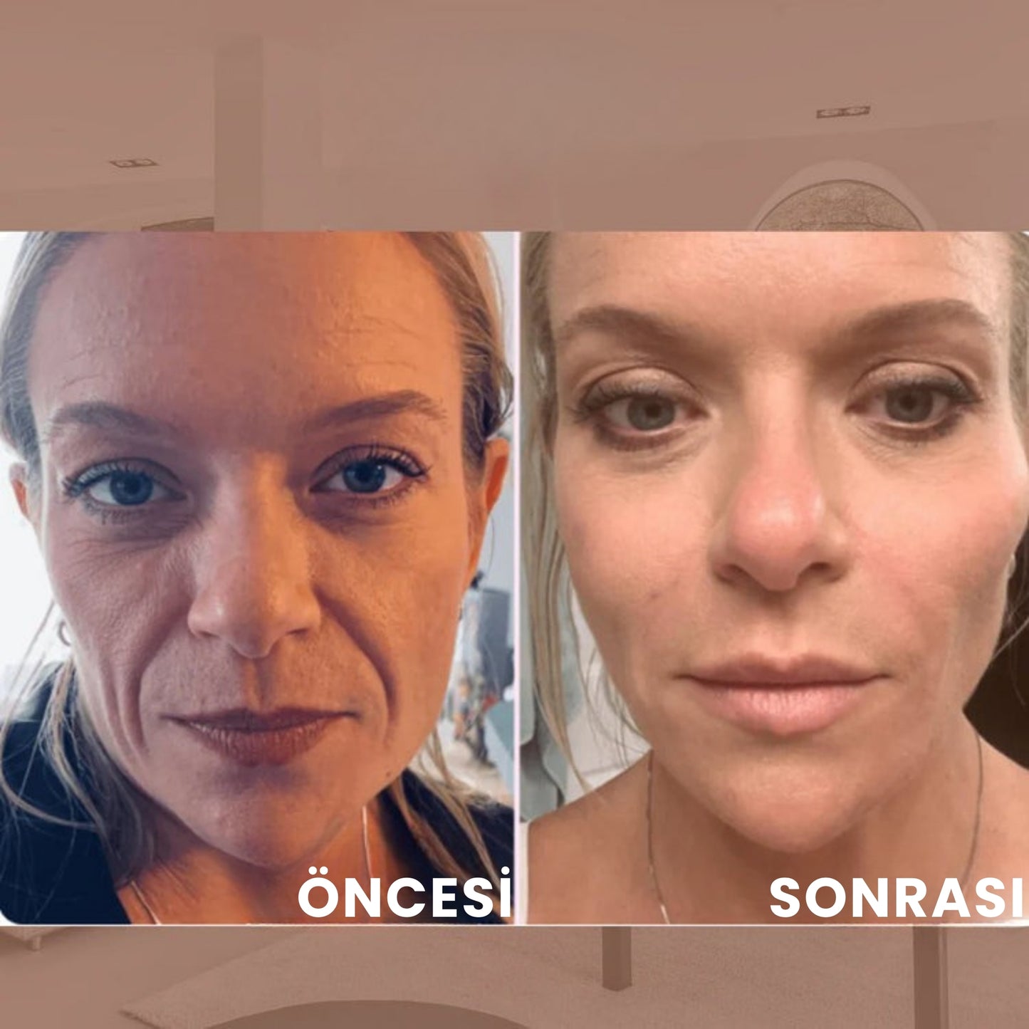 Viamark™ LIFTGENIC Görünmez Yüz ve Boyun Germe Bandı